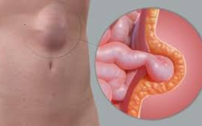 Laparoscopic hernia bulge illustration showing abdominal hernia before surgery