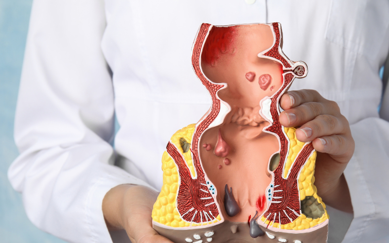 Anal Fistula