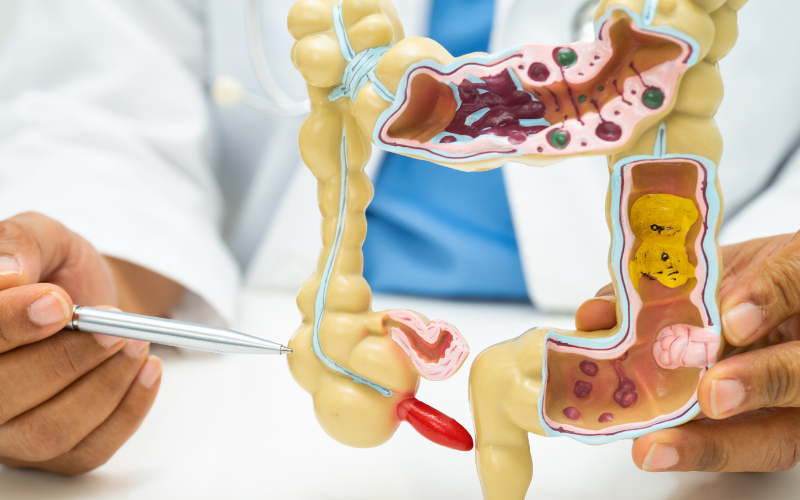 Appendicectomy (Appendix Removal)
