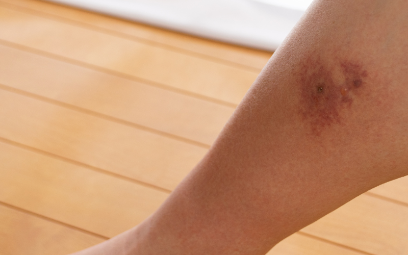 Cellulitis