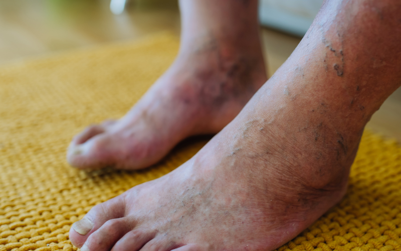 Diabetic Foot
