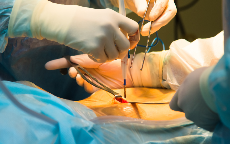 Laparoscopy Surgery