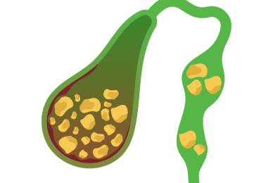 Gallbladder Stone Removal