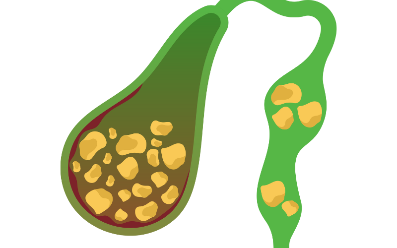 Gallbladder Stone Removal
