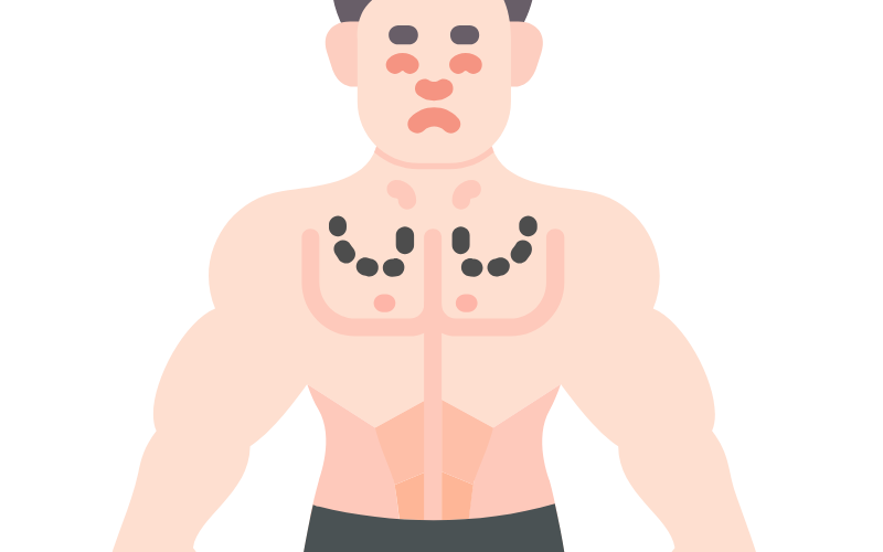 Gynecomastia