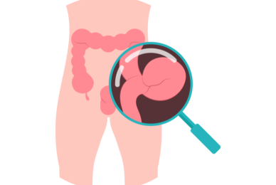 Hernia surgery