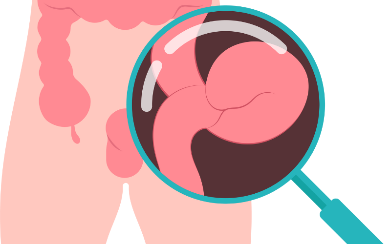 Hiatus Hernia
