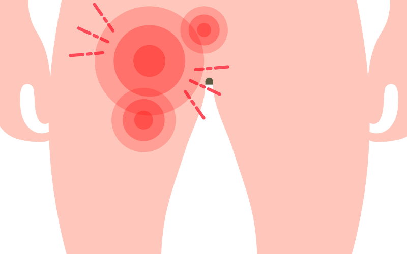 Hydrocele