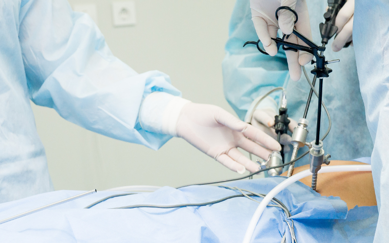 Laparoscopic Appendectomy