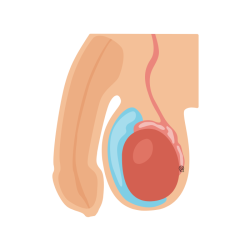 Hydrocele Operation