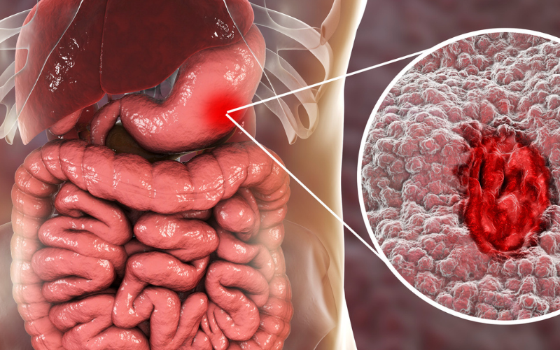 Ulcerative Colitis