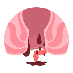 Piles